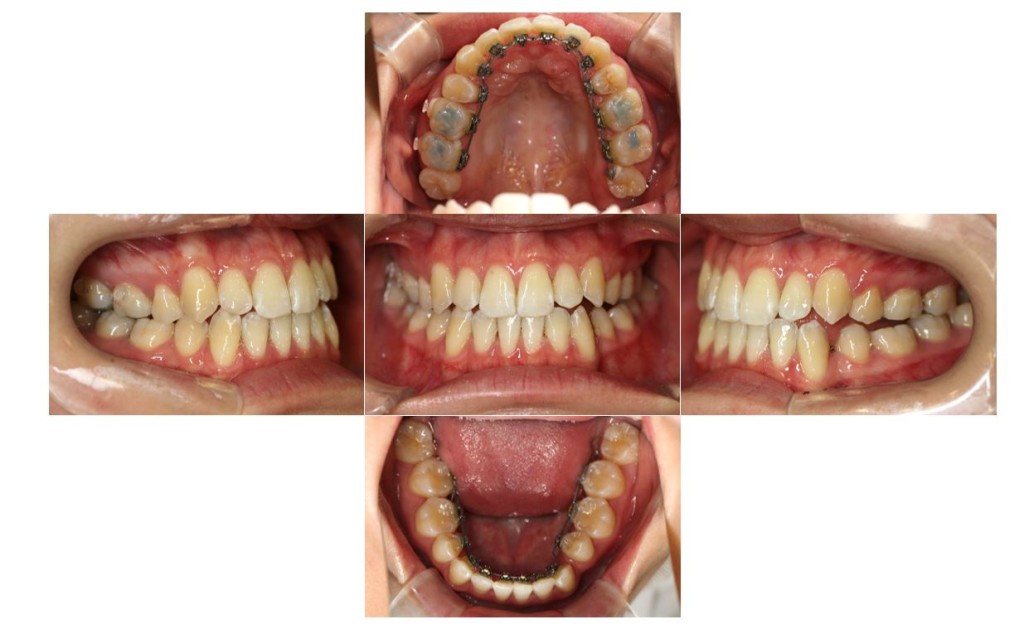 リンガル・受け口の症例