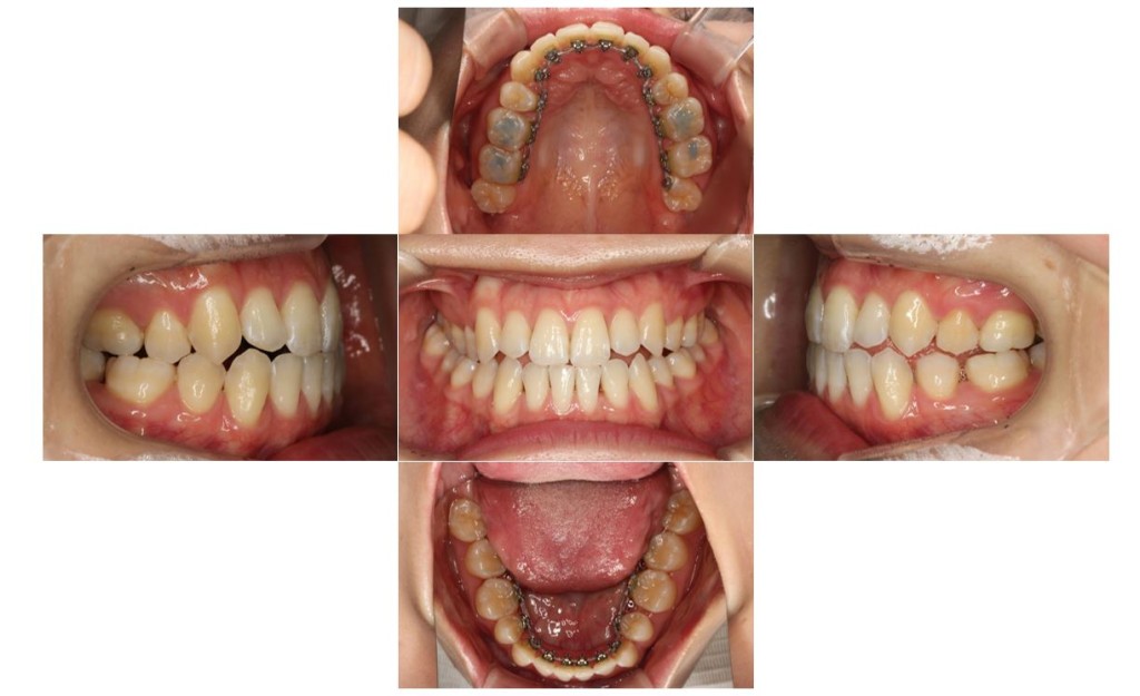 リンガル・受け口の症例