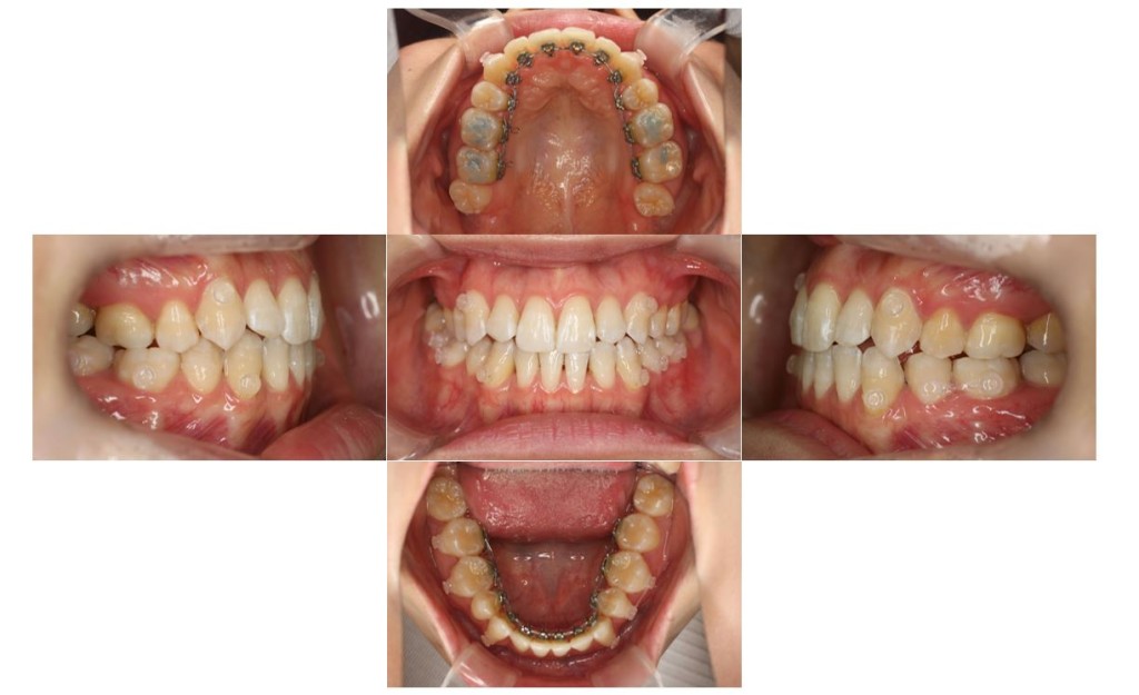 リンガル・受け口の症例