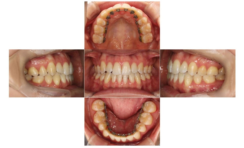 リンガル・受け口の症例