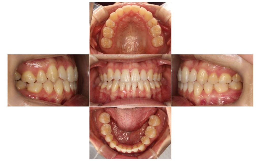 リンガル・受け口の症例