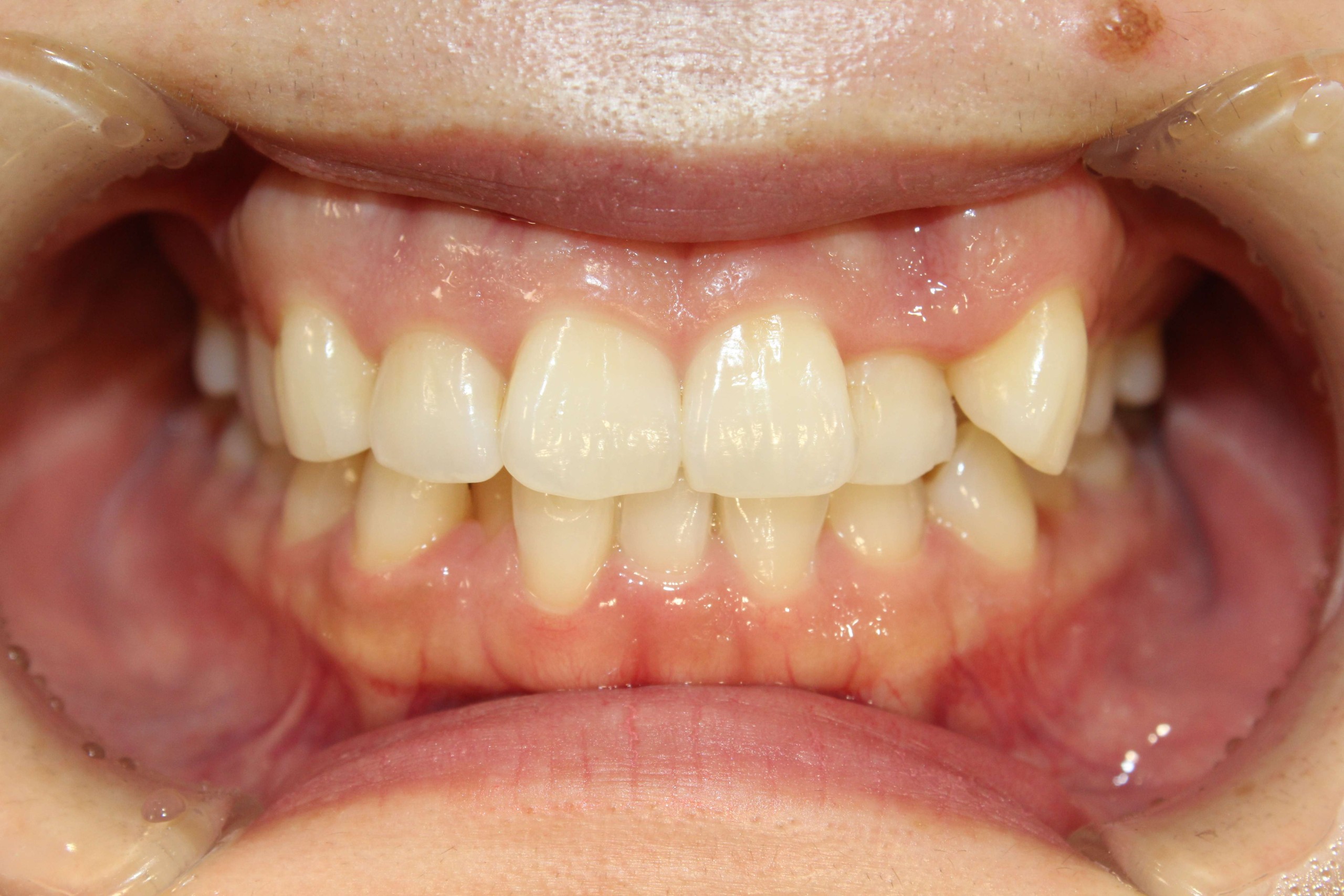 ガタツキ・リンガルの症例