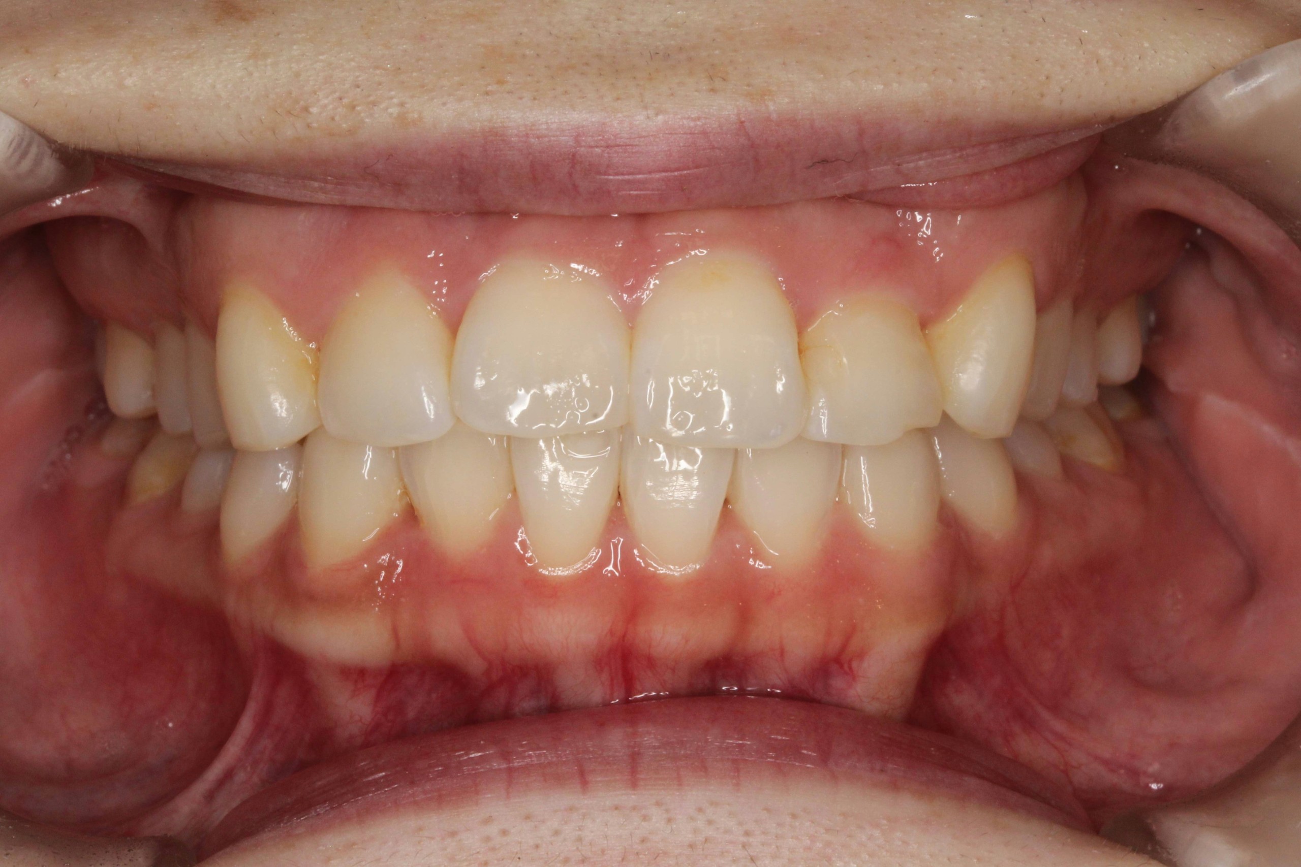 ガタツキ・リンガルの症例