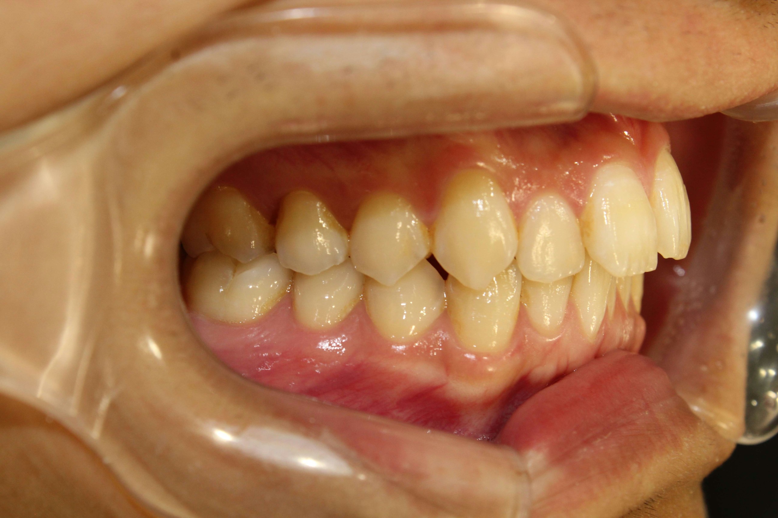 出っ歯・リンガルの症例