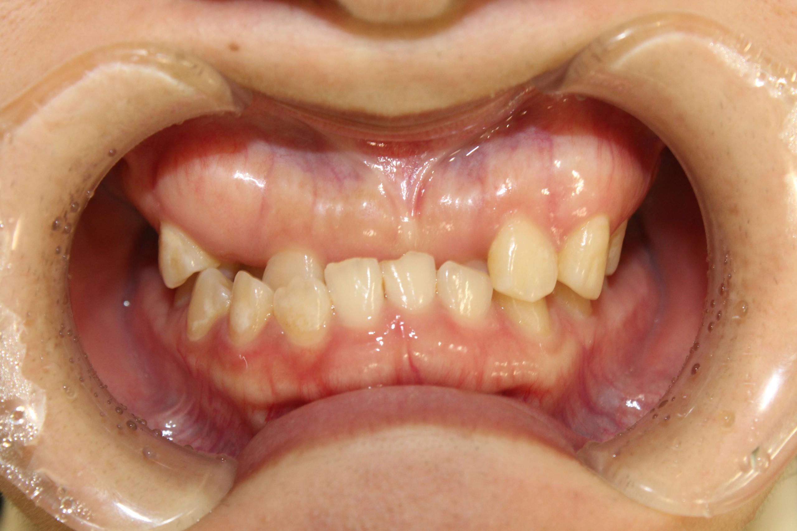 受け口・リンガルの症例