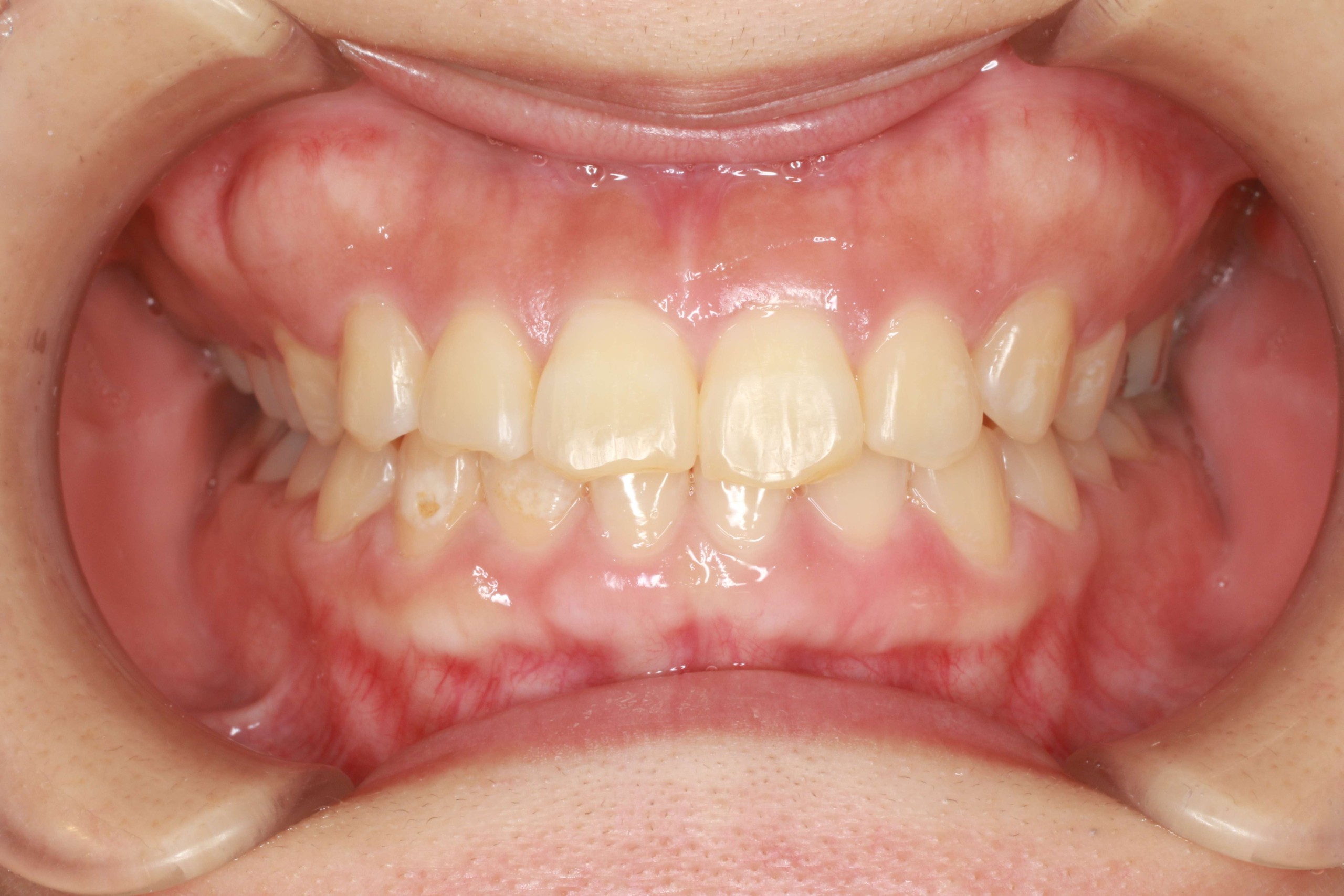 受け口・リンガルの症例