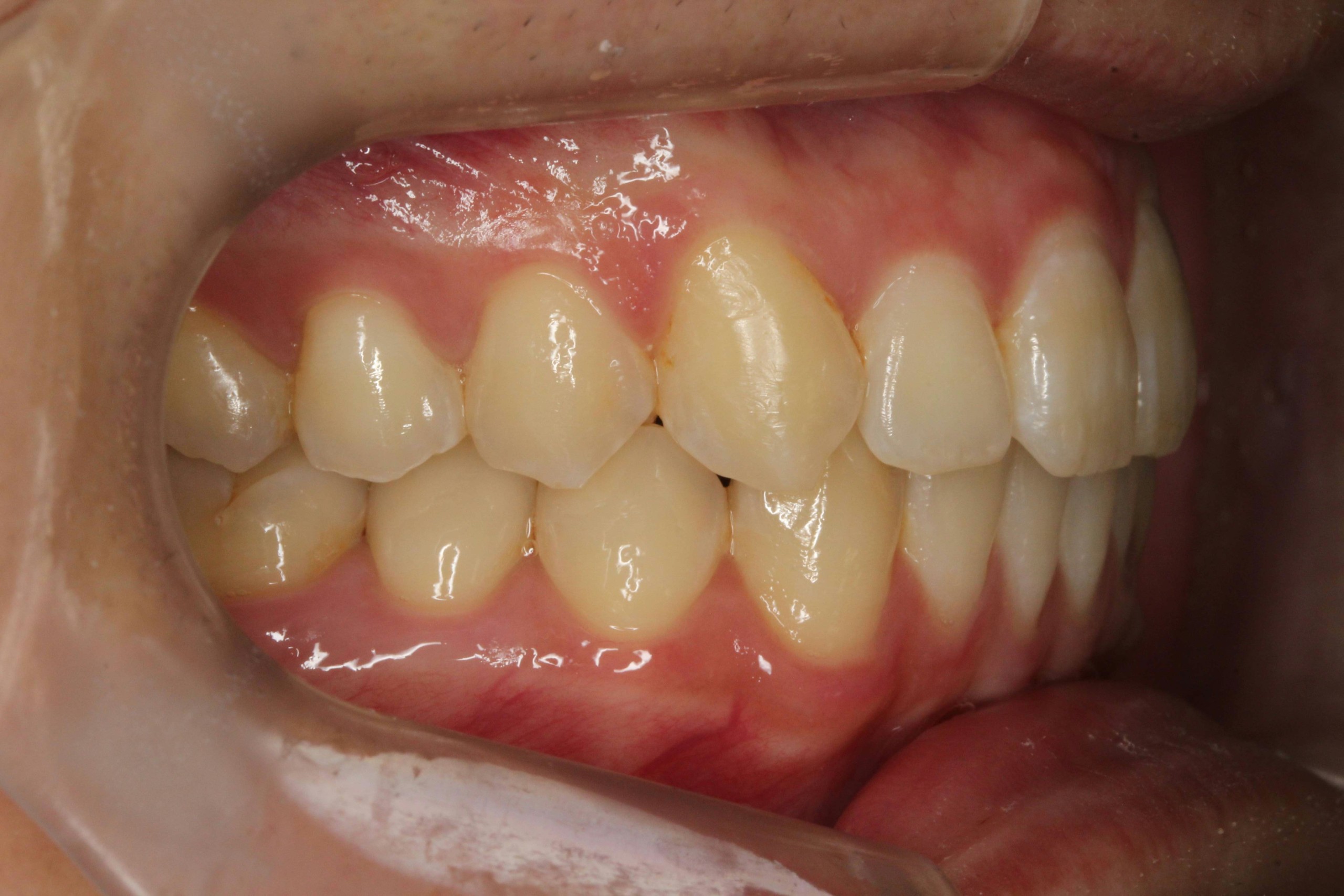 出っ歯・リンガルの症例