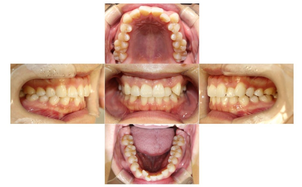 ガタツキ・リンガルの症例