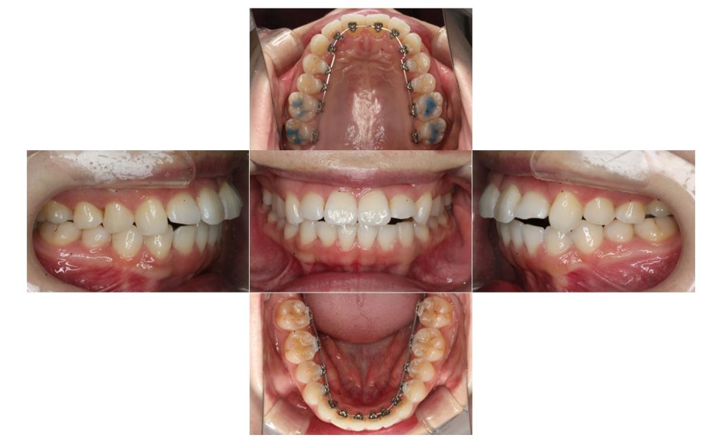 ガタツキ・リンガルの症例