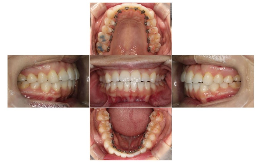 ガタツキ・リンガルの症例