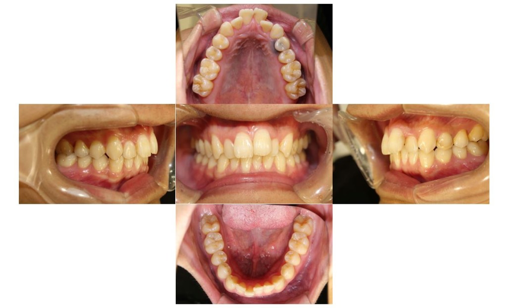 出っ歯・リンガルの症例