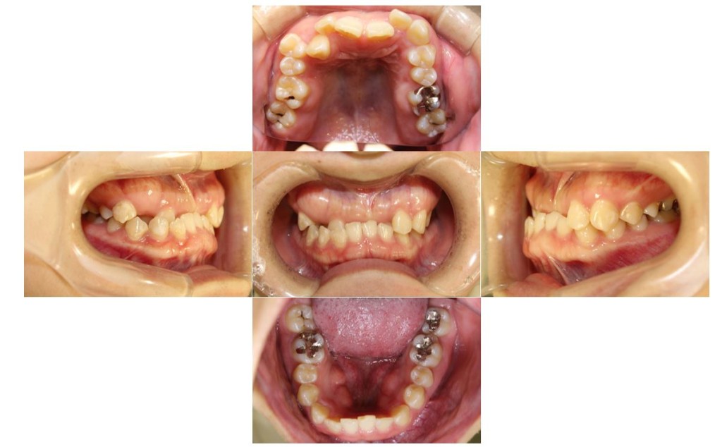 受け口・リンガルの症例