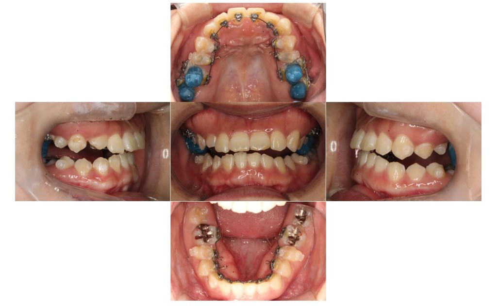 受け口・リンガルの症例 