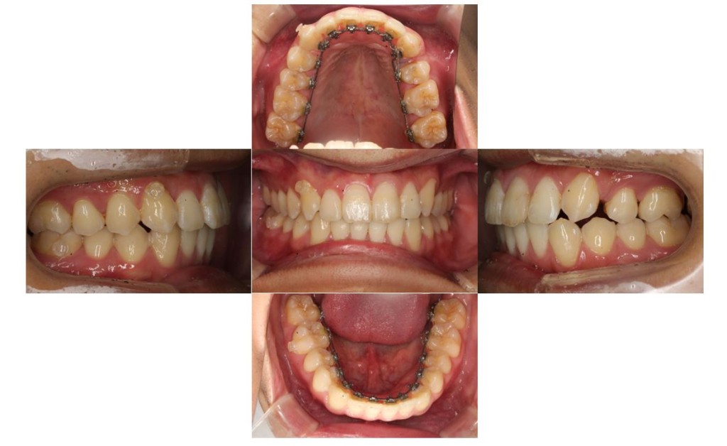 出っ歯・リンガルの症例