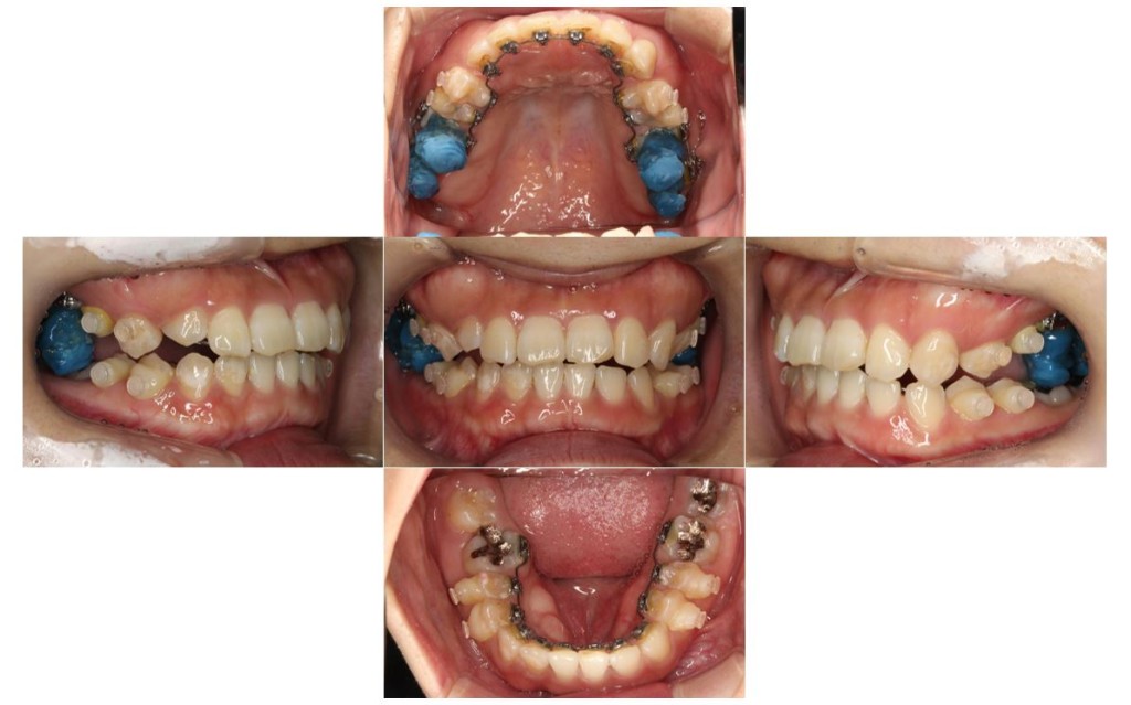 受け口・リンガルの症例