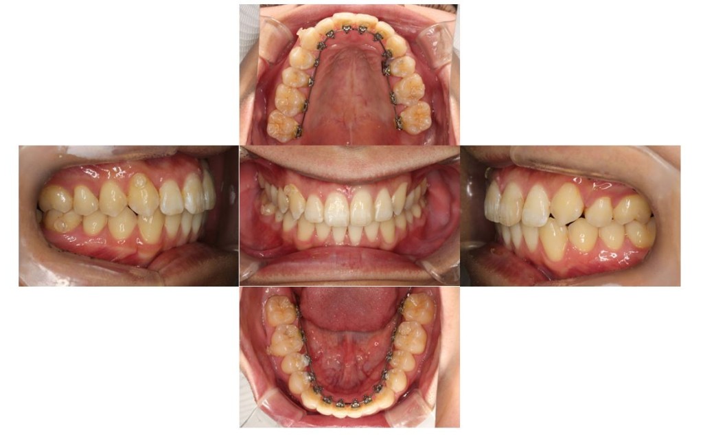 出っ歯・リンガルの症例
