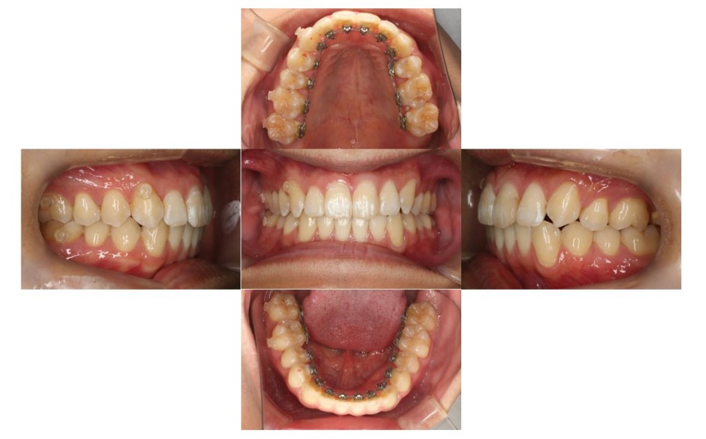 出っ歯・リンガルの症例