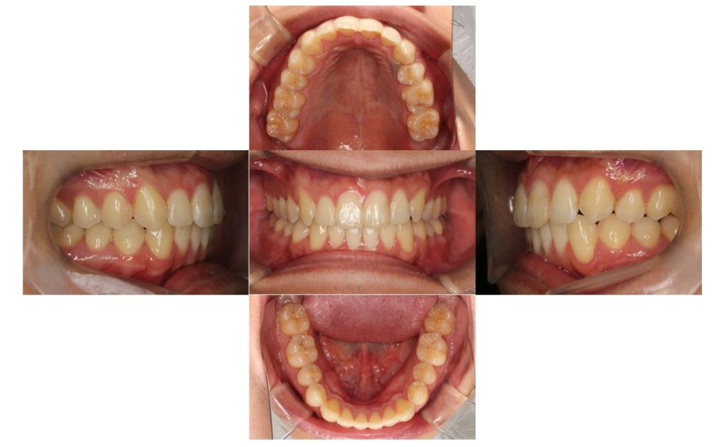 出っ歯・リンガルの症例