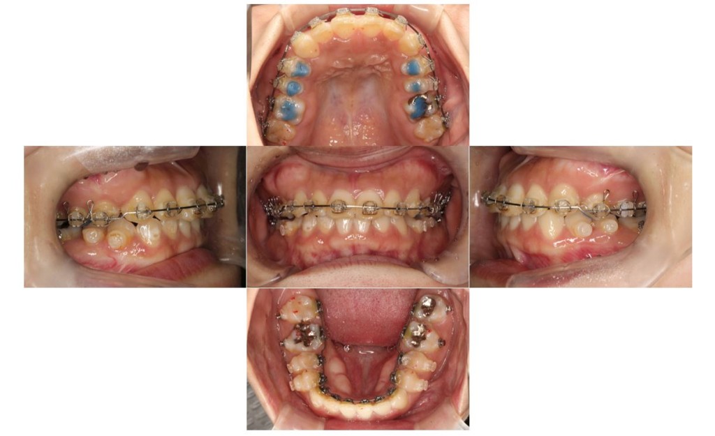 受け口・リンガルの症例