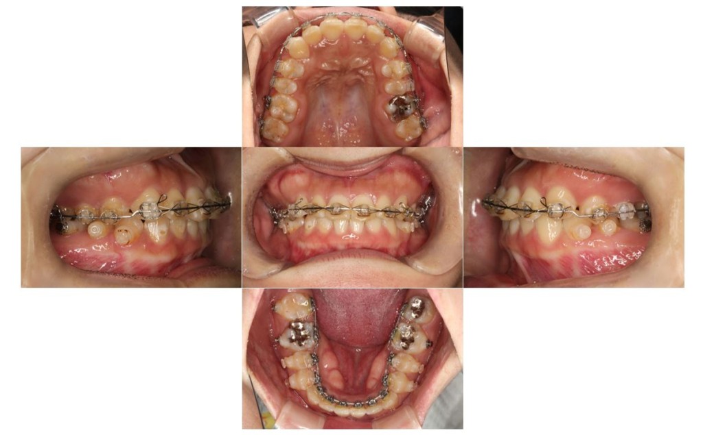 受け口・リンガルの症例