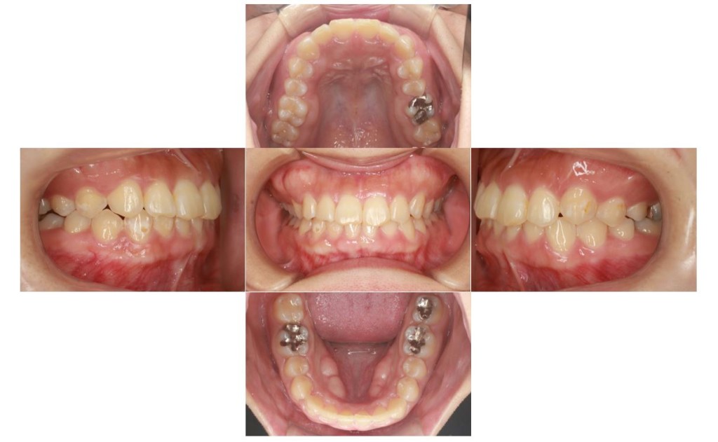 受け口・リンガルの症例