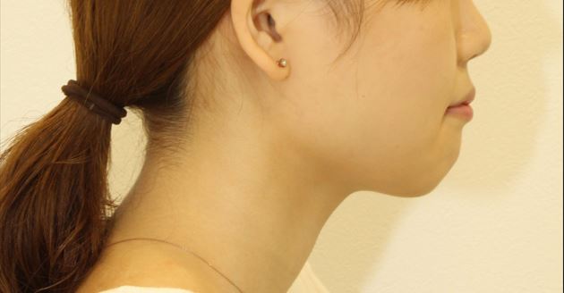 上の歯が出ている・ハーフリンガルの症例