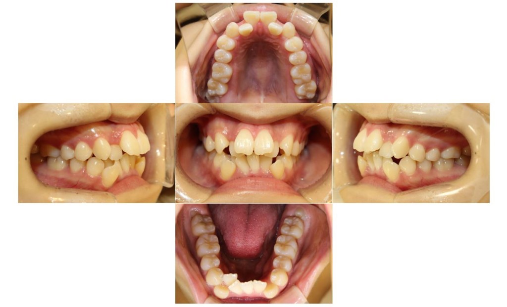 上の歯が出ている・ハーフリンガルの症例