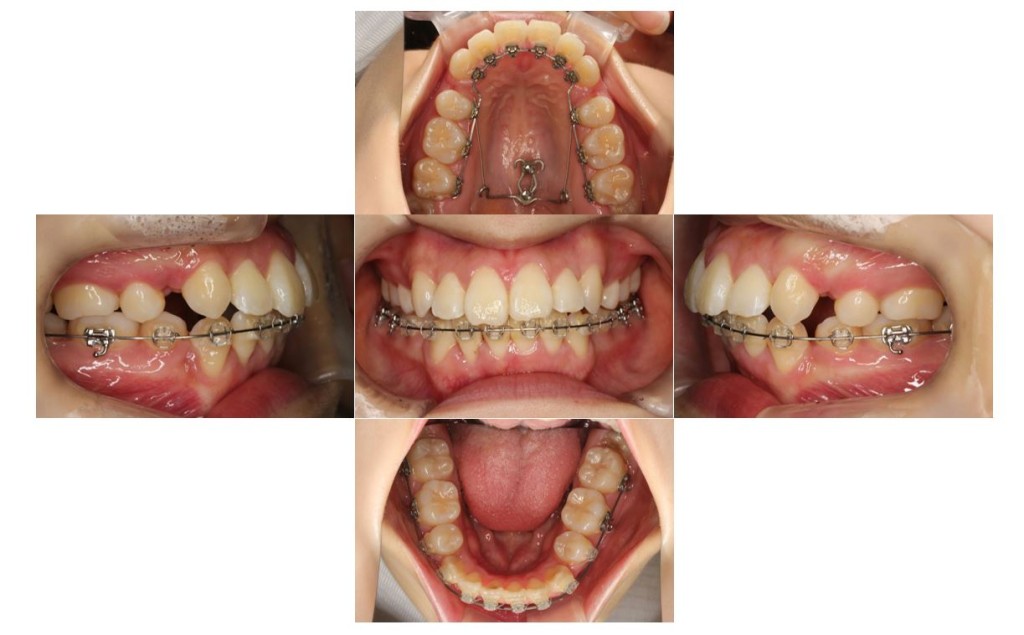 上の歯が出ている・ハーフリンガルの症例
