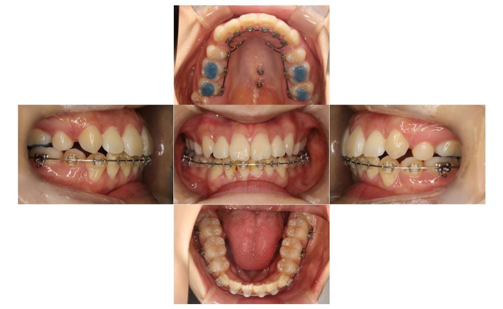 上の歯が出ている・ハーフリンガルの症例