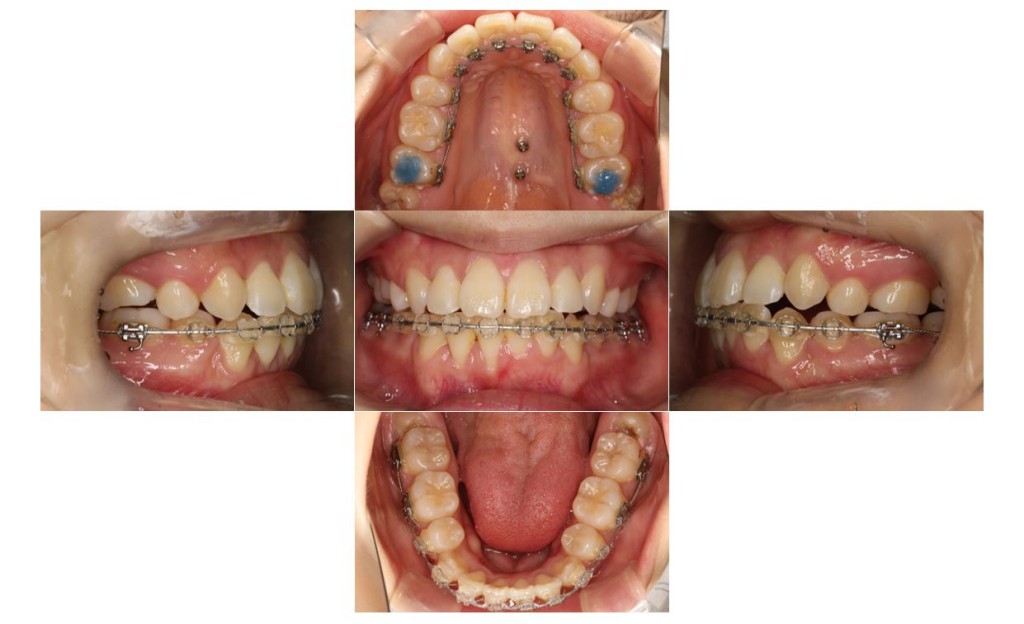 上の歯が出ている・ハーフリンガルの症例