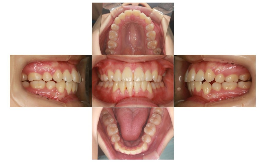 上の歯が出ている・ハーフリンガルの症例